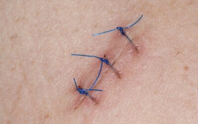 Jakie środki są najlepsze na blizny?